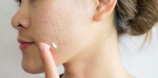 Tretinoin Picture Ii