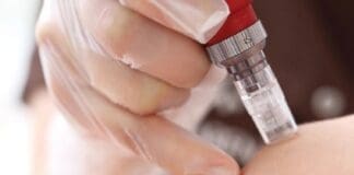 Microneedling 5070