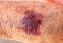 The Unsightly Medical Condition: Actinic Purpura Coastal Skin Surgery 6641