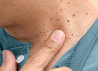 Tag, You’re It! Let’s Talk About Skin Tags Coastal Skin Surgery Skin Tags