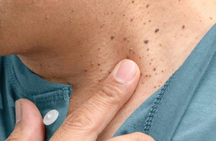 Coastal Skin Surgery Skin Tags